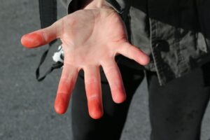 hand red with frostbite hand red with frostbite